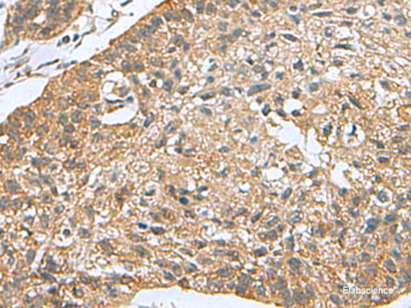 Immunohistochemistry of paraffin-embedded Human esophagus cancer tissue using PDCD5 Polyclonal Antibody at dilution of 1:105(×200)