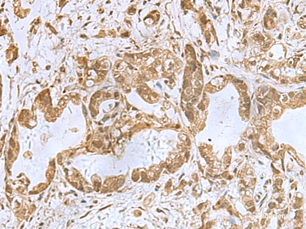 Immunohistochemistry of paraffin-embedded Human gastric cancer tissue using PHF6 Polyclonal Antibody at dilution of 1:85(×200)