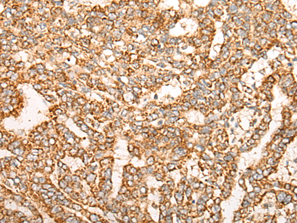 Immunohistochemistry of paraffin-embedded Human liver cancer tissue using NR0B2 Polyclonal Antibody at dilution of 1:35(×200)