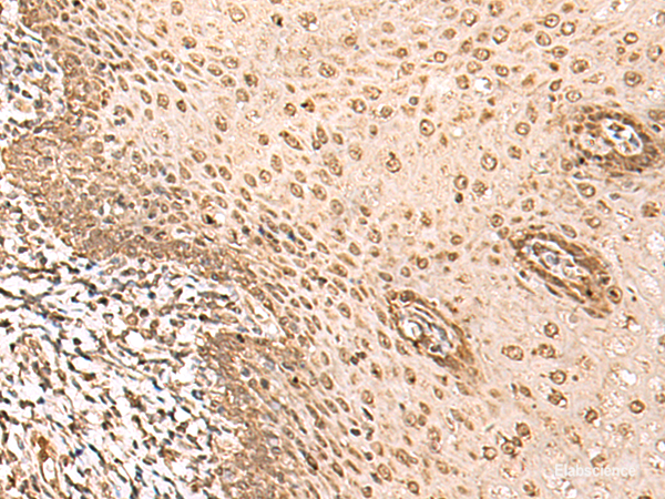Immunohistochemistry of paraffin-embedded Human esophagus cancer tissue using BAP1 Polyclonal Antibody at dilution of 1:35(×200)