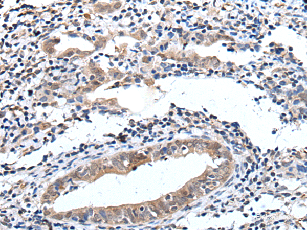 Immunohistochemistry of paraffin-embedded Human cervical cancer tissue using ELMO1 Polyclonal Antibody at dilution of 1:40(×200)