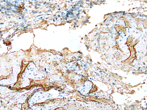Immunohistochemistry of paraffin-embedded Human cervical cancer tissue using LDHD Polyclonal Antibody at dilution of 1:120(×200)