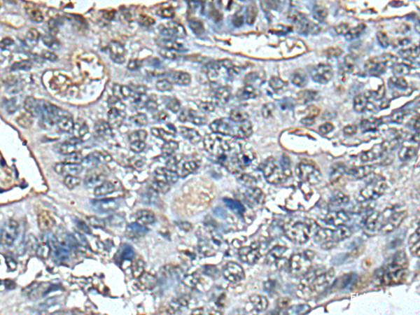Immunohistochemistry of paraffin-embedded Human colorectal cancer tissue using STRADA Polyclonal Antibody at dilution of 1:85(×200)