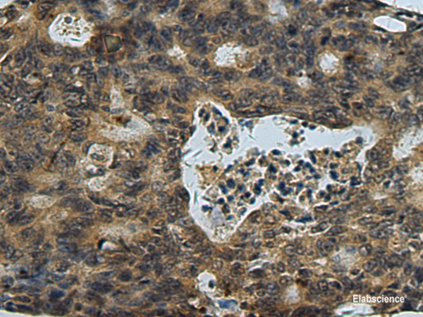 Immunohistochemistry of paraffin-embedded Human colorectal cancer tissue using PLTP Polyclonal Antibody at dilution of 1:60(×200)