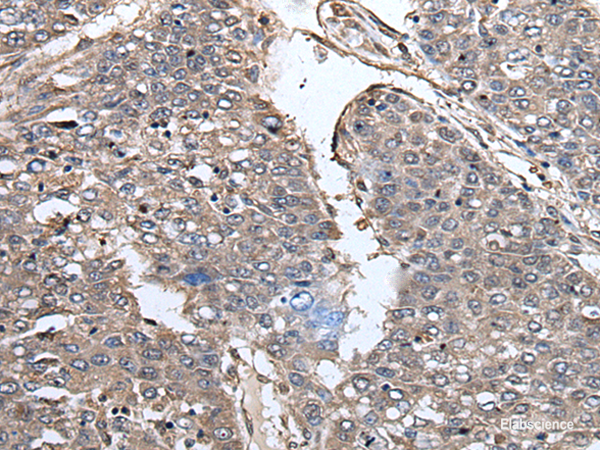 Immunohistochemistry of paraffin-embedded Human liver cancer tissue using PRUNE Polyclonal Antibody at dilution of 1:40(×200)