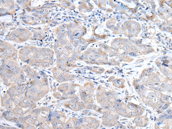Immunohistochemistry of paraffin-embedded Human breast cancer tissue using RASA1 Polyclonal Antibody at dilution of 1:45(×200)