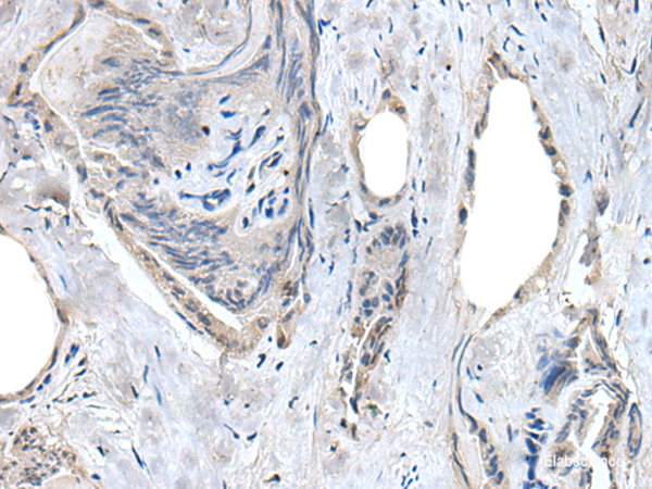 Immunohistochemistry of paraffin-embedded Human thyroid cancer tissue using RASSF8 Polyclonal Antibody at dilution of 1:55(×200)