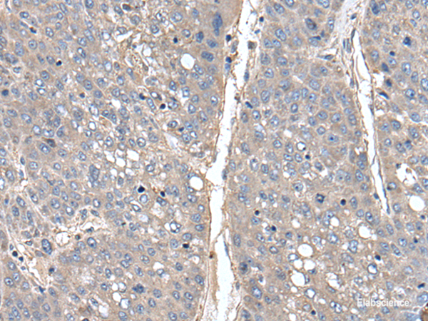 Immunohistochemistry of paraffin-embedded Human liver cancer tissue using THAP10 Polyclonal Antibody at dilution of 1:40(×200)