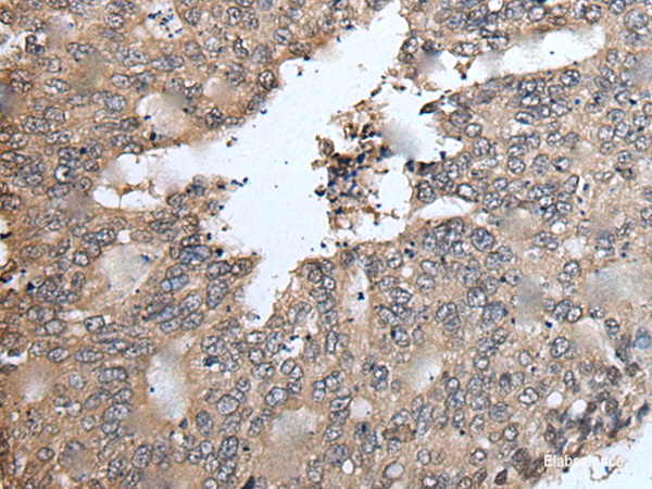 Immunohistochemistry of paraffin-embedded Human colorectal cancer tissue using TRIM23 Polyclonal Antibody at dilution of 1:55(×200)