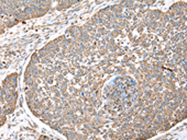 Immunohistochemistry of paraffin-embedded Human lung cancer tissue using DPH7 Polyclonal Antibody at dilution of 1:40(×200)