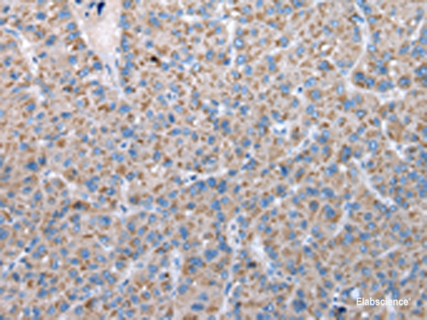 Immunohistochemistry of paraffin-embedded Human liver cancer tissue using FKBPL Polyclonal Antibody at dilution of 1:50(×200)