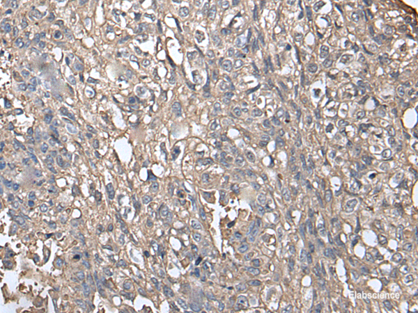 Immunohistochemistry of paraffin-embedded Human lung cancer tissue using NDUFB5 Polyclonal Antibody at dilution of 1:45(×200)