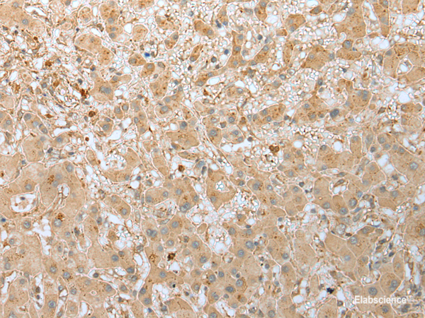 Immunohistochemistry of paraffin-embedded Human liver cancer tissue using FNDC3B Polyclonal Antibody at dilution of 1:45(×200)