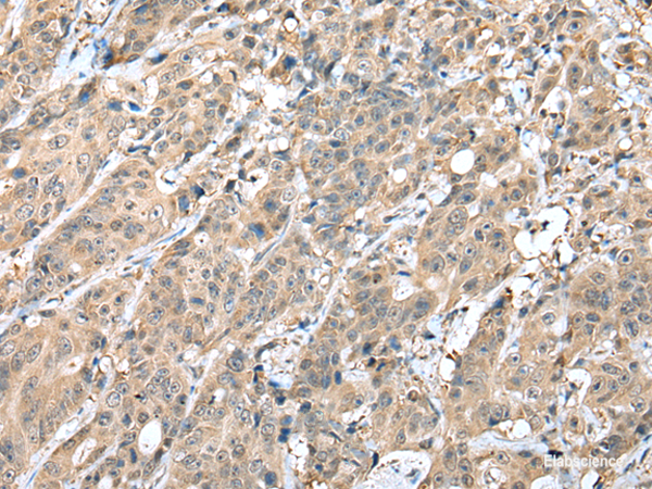 Immunohistochemistry of paraffin-embedded Human colorectal cancer tissue using HIF1A Polyclonal Antibody at dilution of 1:45(×200)