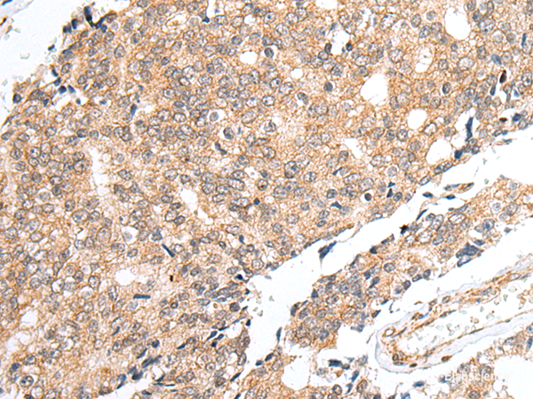 Immunohistochemistry of paraffin-embedded Human prost at e cancer tissue using PRELID1 Polyclonal Antibody at dilution of 1:40(×200)