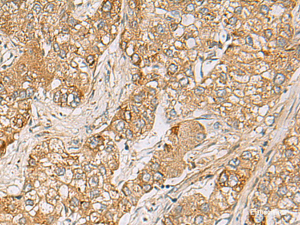 Immunohistochemistry of paraffin-embedded Human liver cancer tissue using LRRC28 Polyclonal Antibody at dilution of 1:80(×200)