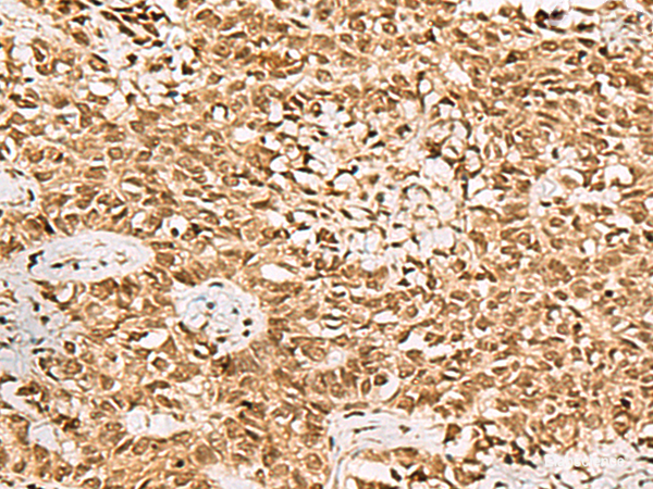 Immunohistochemistry of paraffin-embedded Human ovarian cancer tissue using LRRC2 Polyclonal Antibody at dilution of 1:70(×200)