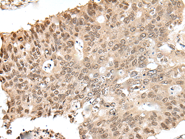 Immunohistochemistry of paraffin-embedded Human colorectal cancer tissue using ZNF410 Polyclonal Antibody at dilution of 1:40(×200)