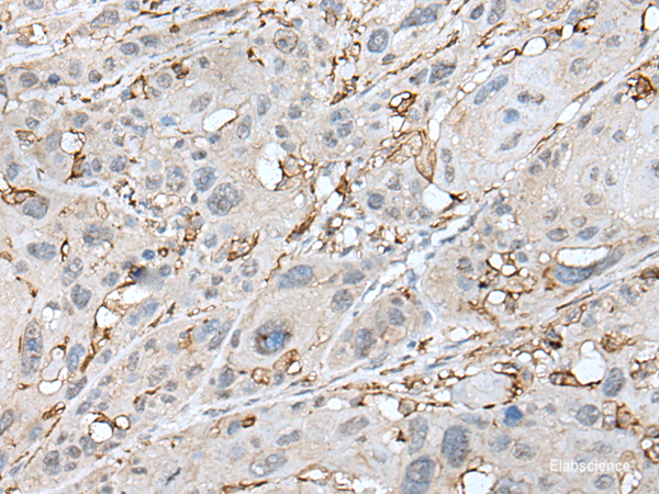 Immunohistochemistry of paraffin-embedded Human esophagus cancer tissue using CD14 Polyclonal Antibody at dilution of 1:40(×200)