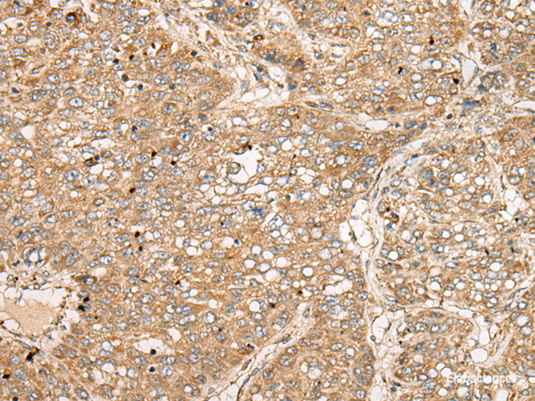 Immunohistochemistry of paraffin-embedded Human liver cancer tissue using TDGF1 Polyclonal Antibody at dilution of 1:50(×200)