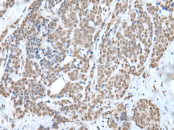 Immunohistochemistry of paraffin-embedded Human thyroid cancer tissue using WTAP Polyclonal Antibody at dilution of 1:35(×200)
