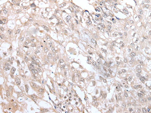 Immunohistochemistry of paraffin-embedded Human lung cancer tissue using VRK3 Polyclonal Antibody at dilution of 1:45(×200)