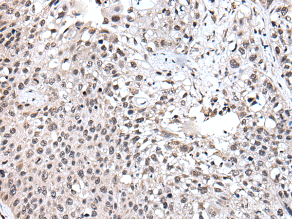 Immunohistochemistry of paraffin-embedded Human lung cancer tissue using UBE2E3 Polyclonal Antibody at dilution of 1:40(×200)