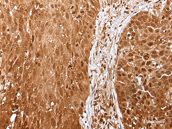 Immunohistochemistry of paraffin-embedded Human lung cancer tissue using UBA7 Polyclonal Antibody at dilution of 1:35(×200)