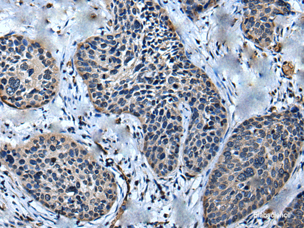 Immunohistochemistry of paraffin-embedded Human cervical cancer tissue using ULK4 Polyclonal Antibody at dilution of 1:75(×200)