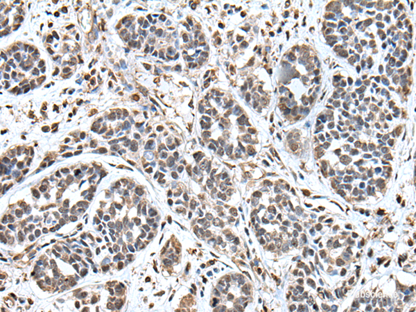 Immunohistochemistry of paraffin-embedded Human esophagus cancer tissue using UPK3A Polyclonal Antibody at dilution of 1:55(×200)