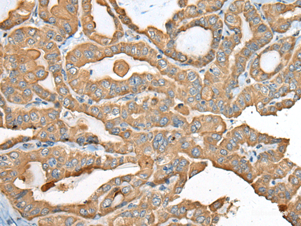 Immunohistochemistry of paraffin-embedded Human thyroid cancer tissue using USP12 Polyclonal Antibody at dilution of 1:35(×200)