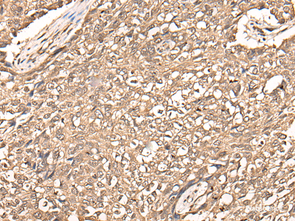 Immunohistochemistry of paraffin-embedded Human lung cancer tissue using USP21 Polyclonal Antibody at dilution of 1:50(×200)
