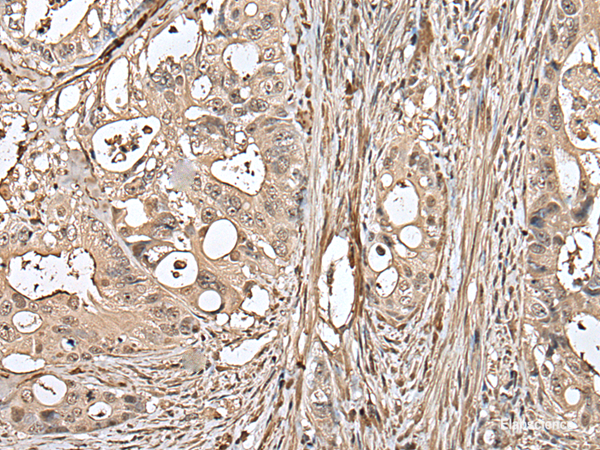 Immunohistochemistry of paraffin-embedded Human colorectal cancer tissue using UTP3 Polyclonal Antibody at dilution of 1:50(×200)