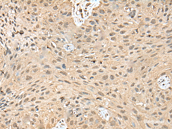Immunohistochemistry of paraffin-embedded Human lung cancer tissue using ATXN3 Polyclonal Antibody at dilution of 1:50(×200)