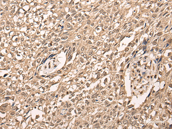 Immunohistochemistry of paraffin-embedded Human lung cancer tissue using ATF7 Polyclonal Antibody at dilution of 1:40(×200)