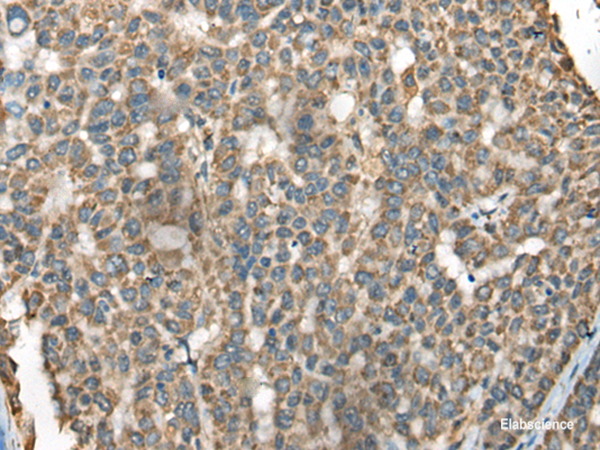 Immunohistochemistry of paraffin-embedded Human liver cancer tissue using BLNK Polyclonal Antibody at dilution of 1:65(×200)
