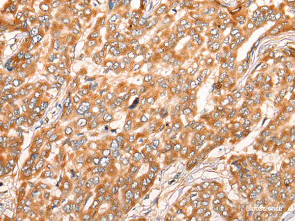 Immunohistochemistry of paraffin-embedded Human liver cancer tissue using ZMYND10 Polyclonal Antibody at dilution of 1:35(×200)