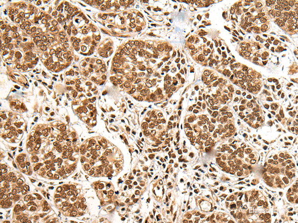 Immunohistochemistry of paraffin-embedded Human esophagus cancer tissue using BRSK1 Polyclonal Antibody at dilution of 1:95(×200)