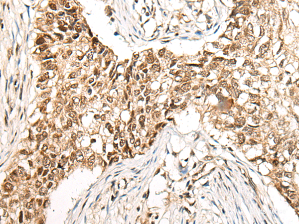 Immunohistochemistry of paraffin-embedded Human lung cancer tissue using CCDC181 Polyclonal Antibody at dilution of 1:50(×200)