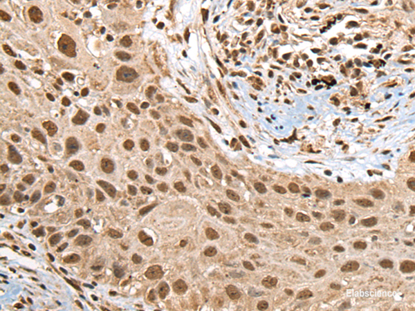 Immunohistochemistry of paraffin-embedded Human lung cancer tissue using RTCB Polyclonal Antibody at dilution of 1:45(×200)