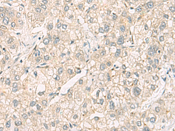 Immunohistochemistry of paraffin-embedded Human liver cancer tissue using C3orf38 Polyclonal Antibody at dilution of 1:95(×200)