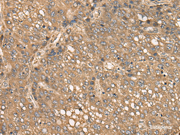 Immunohistochemistry of paraffin-embedded Human liver cancer tissue using C4BPB Polyclonal Antibody at dilution of 1:35(×200)