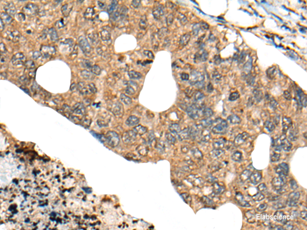Immunohistochemistry of paraffin-embedded Human colorectal cancer tissue using PPP3R1 Polyclonal Antibody at dilution of 1:80(×200)
