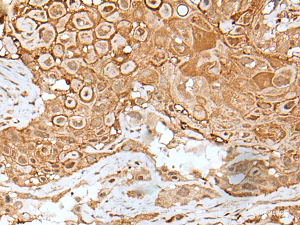 Immunohistochemistry of paraffin-embedded Human esophagus cancer tissue using IL6ST Polyclonal Antibody at dilution of 1:40(×200)