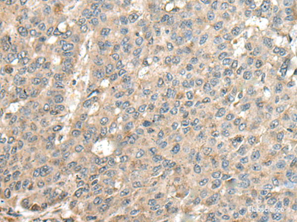 Immunohistochemistry of paraffin-embedded Human liver cancer tissue using CASQ1 Polyclonal Antibody at dilution of 1:100(×200)