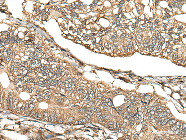 Immunohistochemistry of paraffin-embedded Human gastric cancer tissue using CA11 Polyclonal Antibody at dilution of 1:30(×200)