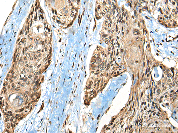 Immunohistochemistry of paraffin-embedded Human esophagus cancer tissue using CASK Polyclonal Antibody at dilution of 1:65(×200)