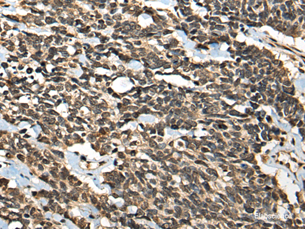 Immunohistochemistry of paraffin-embedded Human lung cancer tissue using MICU1 Polyclonal Antibody at dilution of 1:35(×200)