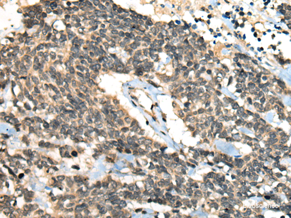 Immunohistochemistry of paraffin-embedded Human lung cancer tissue using CCNB1IP1 Polyclonal Antibody at dilution of 1:30(×200)