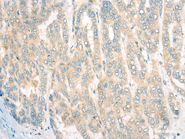 Immunohistochemistry of paraffin-embedded Human liver cancer tissue using CDKAL1 Polyclonal Antibody at dilution of 1:60(×200)